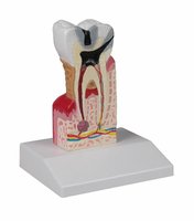 10× zvětšený model zubního kazu